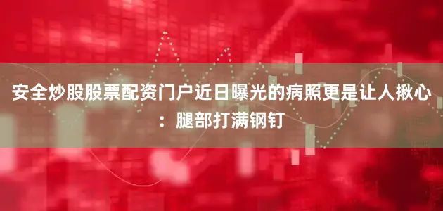 安全炒股股票配资门户近日曝光的病照更是让人揪心：腿部打满钢钉